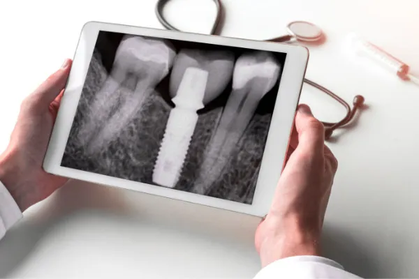 Radiografie implant dentar